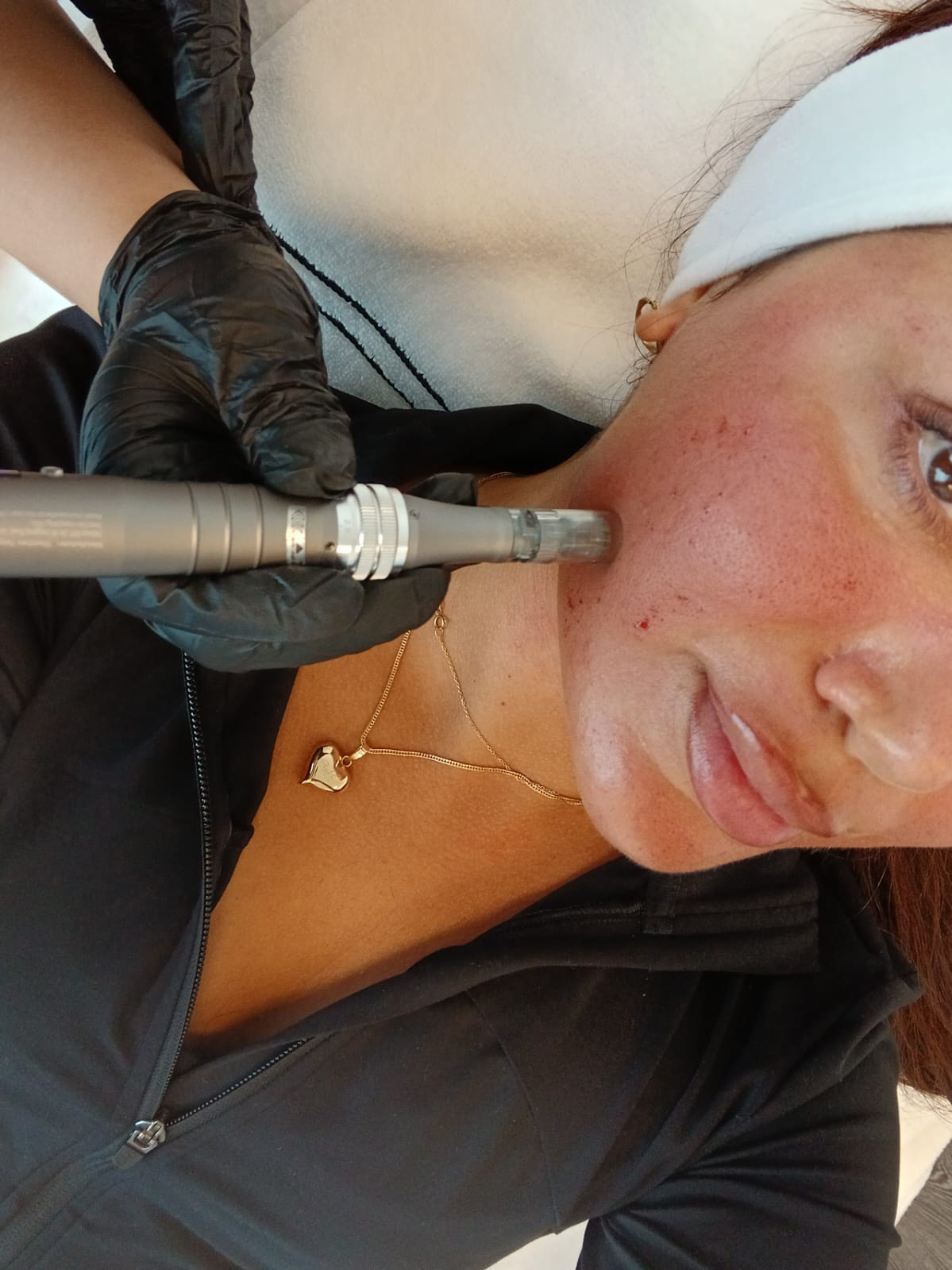 Microneedling-behandling