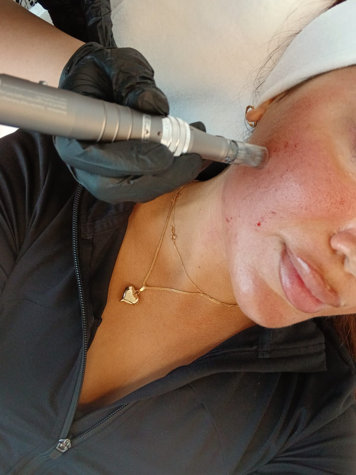 Microneedling-behandling i ansiktet